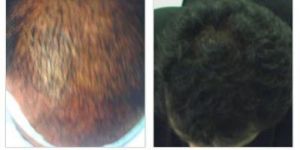 Hair Regrowth Treatment Clinic in Bangalore