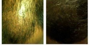 Hair Transplantation