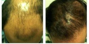 Hair Transplantation Services