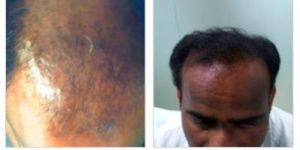PRP for Hair Loss in Bangalore, Platelet Rich Plasma for Hair Loss