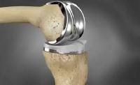 Knee Prostheses