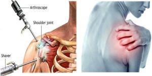 Yoga Treatment for Frozen Shoulder