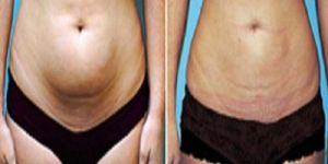 Liposuction Surgery