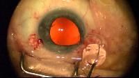 Intraocular Lenses