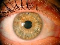 Intraocular Lenses