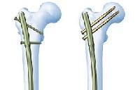 Reconstruction Nail