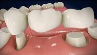 Dental Bridge