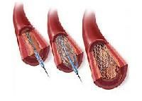 Coronary Stents