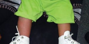 Dennis Brown Splint for Club Foot Ctev