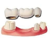 Dental Bridges
