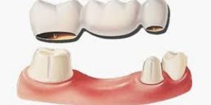 Dental Bridge