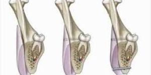 Mandible Implants