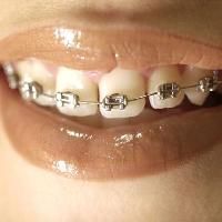 Dental Brace
