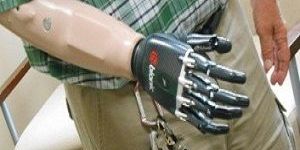 Myoelectric Upper Extremity Prosthesis