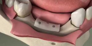 Bone Grafting