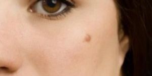 Mole Removal Solution