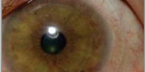 Contact Lenses