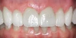 Dental Brace