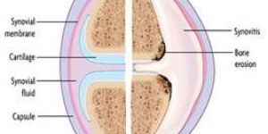 Osteoarthritis Medicine