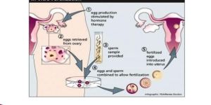 Infertility Treatment