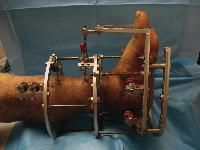 External Fixator