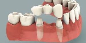 Dental Bridge