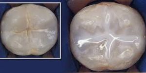 Dental Sealants