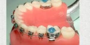 Orthodontic Appliances