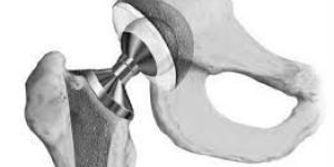 Artificial Hip Joints