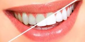 Tooth Whiteners