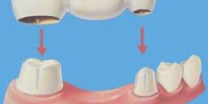 Dental Bridge