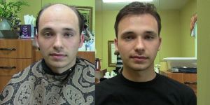 Mens Hair Patch Services