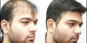 Mens Non Surgical Hair Replacement Services