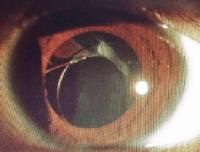 Intraocular Lenses
