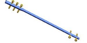 Orthopedic Interlocking Nail