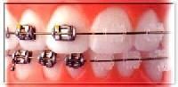 Dental Brace
