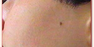 Laser Hair Removal Services