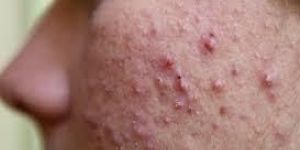 Acne Treatment Services