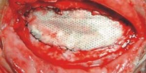 Surgical G-Patch Absorbable