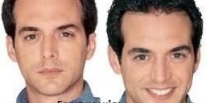 Hair Replacement System