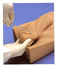 No Scalpel Vasectomy
