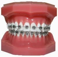 Ceramic Brackets