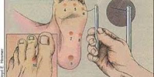 Monofilaments Diabetes