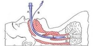 Endotracheal Tube
