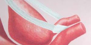 Female Urinary Incontinence Sling