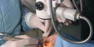 Ophthalmic Microsurgical Knives