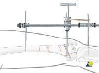 Femoral Nails Knurled Nut