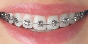 Dental Brace