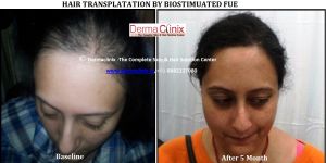 Hair Transplant Surgery