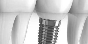 Dental Implants Services